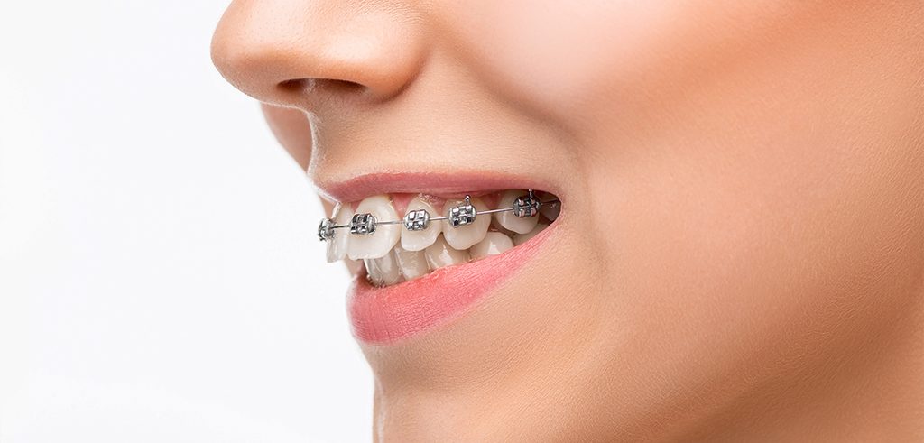 تقويم الأسنان المعدني