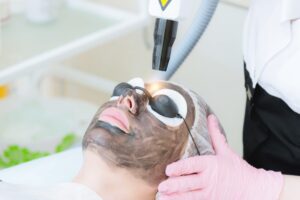 Read more about the article الليزر الكربونى للوجه
