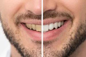 Read more about the article تبييض الأسنان بالليزر