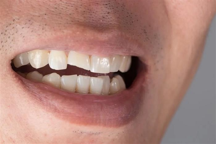أحدث أساليب علاج تآكل الأسنان