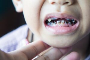 Read more about the article علاج تسوس الأسنان عند الأطفال