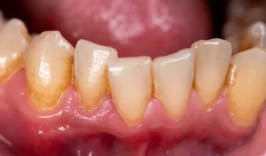 Read more about the article أحدث أساليب علاج تآكل الأسنان