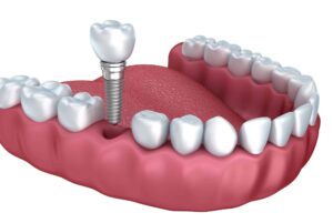 Read more about the article أحدث تقنيات زراعة الأسنان وأهميتها للمرضى فوق سن الأربعين
