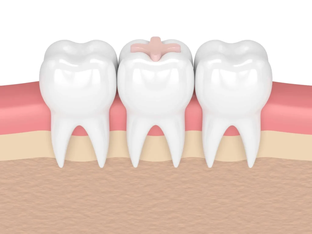 الحشوات التجميلية وتأثيرها على صحة الأسنان