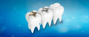 Read more about the article تأثير الحشوات التجميلية على صحة الأسنان