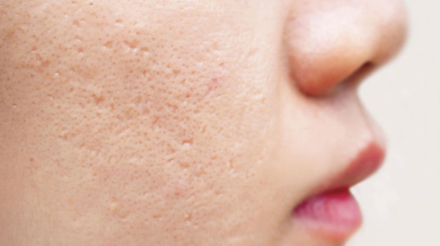 Read more about the article أحدث تقنيات علاج الندبات