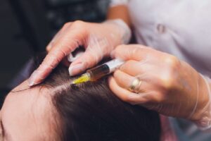 Read more about the article حقن البلازما لعلاج تساقط الشعر