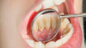 Read more about the article جير الأسنان وأضراره وطرق التخلص منه