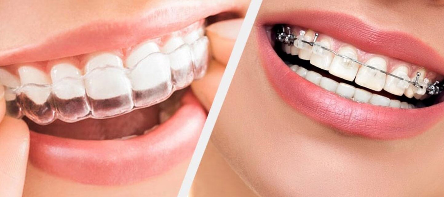 Read more about the article تقويم الأسنان الشفاف أم المعدني؟