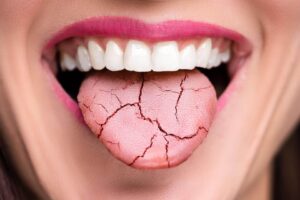 Read more about the article جفاف الفم: الأسباب وطرق العلاج