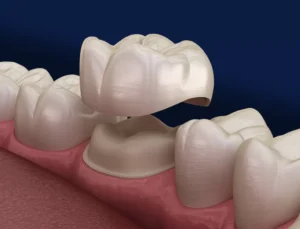 Read more about the article كراون الأسنان: أنواعه، مميزاته، وخطوات تركيبه