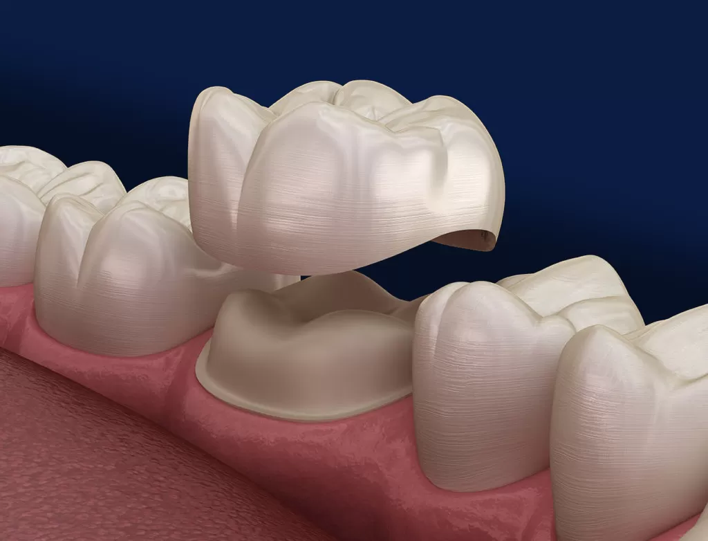Read more about the article كراون الأسنان: أنواعه، مميزاته، وخطوات تركيبه