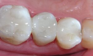 Read more about the article حشوات الأسنان التجميلية: الأنواع والمميزات