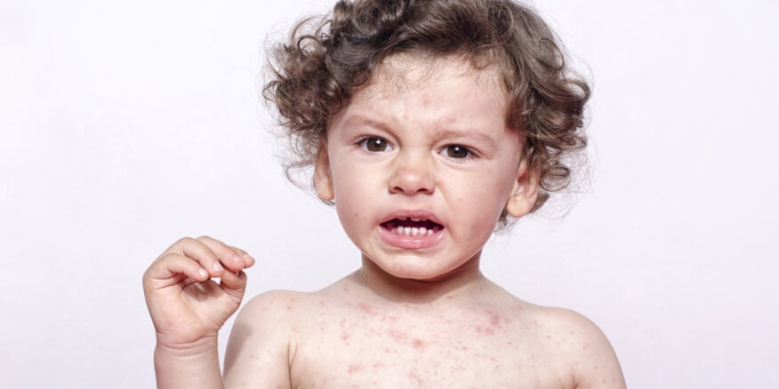 Read more about the article أفضل العلاجات الطبيعية لتخفيف الحساسية لدى الأطفال