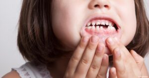 Read more about the article تآكل للأسنان: الأسباب والأعراض وطرق العلاج