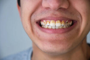 Read more about the article أسباب تغير لون الأسنان وطرق الوقاية والعلاج