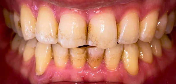 أسباب تغير لون الأسنان وطرق الوقاية والعلاج