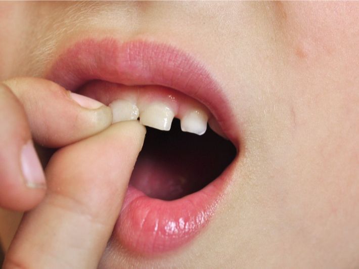 Read more about the article تخلخل الأسنان: الأسباب والأعراض وطرق العلاج